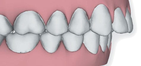 Overbite image