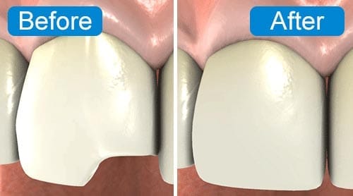 A before and after of teeth whitening