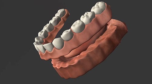 An implant being put into mouth