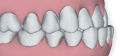 Overbite image